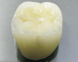 オールセラミッククラウン