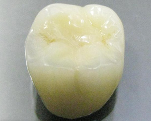 ハイブリッドセラミッククラウン