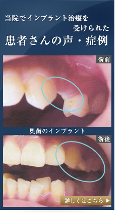 当院でインプラント治療を受けられた患者さんの声・症例