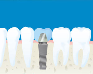 インプラントのメリット